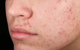 Da sau mụn nhạy cảm kéo dài: Khi hàng rào da chưa thực sự hồi phục