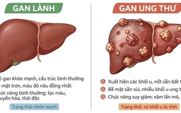 Biến đổi về màu da, nước tiểu cảnh báo ung thư gan Biến đổi về màu da, nước tiểu cảnh báo ung thư gan