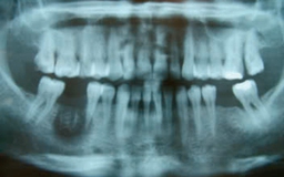 Sử dụng thạch tín trong điều trị nội nha gây nguy cơ gì?