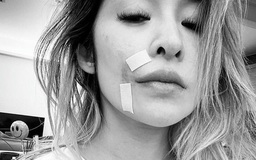 Diva Đài Loan Tiêu Á Hiên biến dạng gương mặt sau khi bị chó tấn công