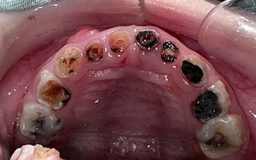 Gây mê chữa răng có phải là 'cho bệnh nhân ngủ để chữa cho nhanh'?