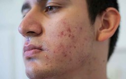 Nam giới bị sẹo rỗ: Khi nào da còn khả năng tăng sinh collagen để cải thiện?