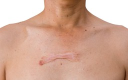 30 - 50% nguy cơ sẹo lồi xuất phát từ một yếu tố ít được nhắc đến