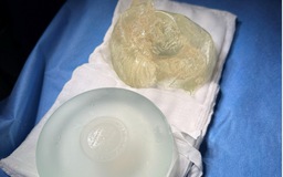 Ths.Bs Hồ Cao Vũ chia sẻ về: Nguyên nhân, dấu hiệu, quy trình tháo túi ngực vỡ