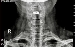 Sai lầm khi trị đau cổ vai gáy có thể gây liệt