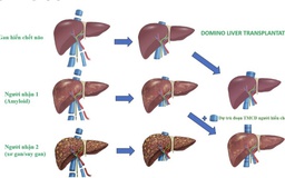 Lần đầu tiên Việt Nam ghép đa tạng domino