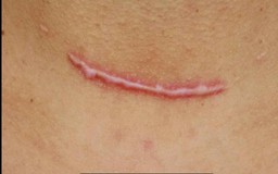 Áp lực cơ học và tăng sinh collagen: Góc nhìn mới trong phòng ngừa sẹo hậu phẫu