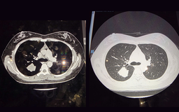 ‘Mắt thần’ trong tầm soát ung thư phổi: Một nốt mờ nhỏ thay đổi tiên lượng sống