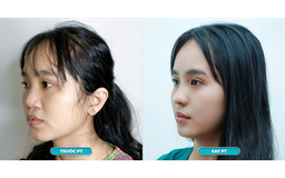 Bệnh viện JK Nhật Hàn miễn phí phẫu thuật 20 case mũi