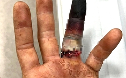 Nhẫn cưới mắc vào cửa xe, tài xế ở TP.HCM nguy cơ mất ngón tay