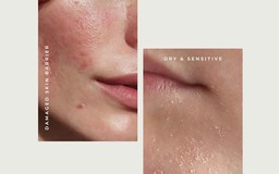 Da yếu là gì? Dấu hiệu và cách phục hồi hiệu quả trong 4 tuần