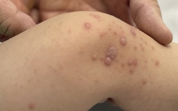 Việt Nam chờ vắc xin tay chân miệng nhập về hạ nhiệt dịch