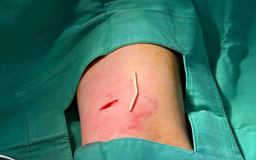 Bệnh viện Phương Nam xử trí ca que tránh thai xuyên sâu vào cơ hiếm gặp