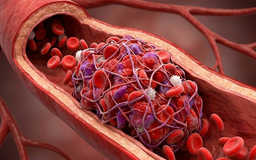 Vì sao tiểu đường lại dễ gây đột quỵ?