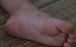 Bệnh tay chân miệng và sốt xuất huyết gia tăng mạnh tại Cần Thơ