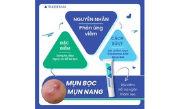 Kem giúp giảm mụn bọc nào đang viral vì hiệu quả sau 4 tuần mà không thâm?