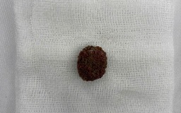 TP.HCM: Tin 'thuốc tan sỏi thận' trên mạng, người đàn ông tắc nghẽn đường niệu