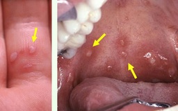 TP.HCM: Biến thể mới gây tay chân miệng nguy hiểm thế nào?