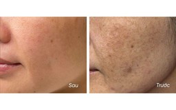 5 kem giúp mờ nám, da trắng sáng sau khoảng 4 tuần, kể cả nám hỗn hợp