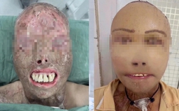 Ngã vào nồi nước sôi và hành trình 16 giờ 'trao trả' gương mặt