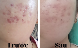 Sẹo thâm có tự hết được không? 99% đều tiếc vì biết điều này quá muộn!