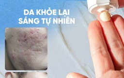 Review chi tiết kem Scar Esthetique làm mờ sẹo rỗ do mụn có tốt không?