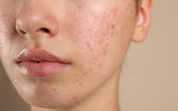 Kháng kháng sinh trong điều trị mụn và giải pháp thay thế từ tia Plasma lạnh