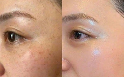 +5 serum mờ nám hỗn hợp, kể cả nám lâu năm cũng cải thiện nhanh chóng +5 serum mờ nám hỗn hợp, kể cả nám lâu năm cũng cải thiện nhanh chóng