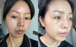 Top 6 serum giúp nám đậm màu cũng bật tone trắng hồng, kể cả nám chân sâu