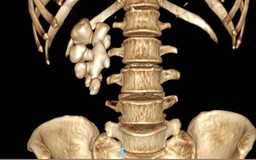 Sỏi thận san hô giống củ gừng nằm trong người nữ bệnh nhân