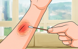 Xử lý vết thương hở đúng cách: Quy trình chăm sóc từ sơ cứu đến phục hồi