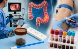 Từ 45 tuổi nên tầm soát ung thư đại trực tràng bằng cách nào?