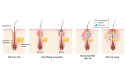 Gel chấm mụn nên dùng khi nào? Những lưu ý trước khi chấm mụn