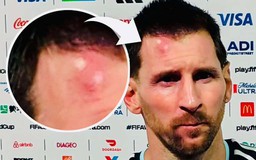 Messi sưng vêu trán sau trận thắng Cabo Verde: Vì sao nên nỗi?
