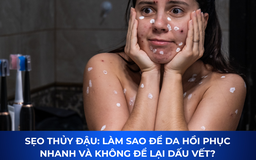 Sẹo thủy đậu có tự hết không? Cách mờ sẹo sau 4 tuần, kể cả lâu năm