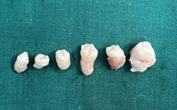 Hy hữu: Khối u trong bụng nữ bệnh nhân chứa 6 chiếc răng
