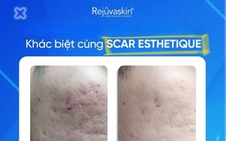 Kem mờ sẹo rỗ nào hiệu quả với cả sẹo lâu năm mà không cần xâm lấn? Kem mờ sẹo rỗ nào hiệu quả với cả sẹo lâu năm mà không cần xâm lấn?