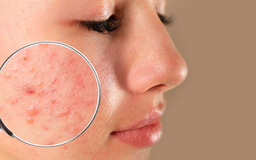 Da dầu mụn, mụn viêm sưng nên dùng gì? Gợi ý routine chuẩn y khoa từ Trioderma Da dầu mụn, mụn viêm sưng nên dùng gì? Gợi ý routine chuẩn y khoa từ Trioderma