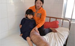 Bé gái 8 tuổi mang chiếc “chân voi”