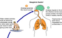 Không tắm ao hồ, bệnh nhi vẫn nhiễm amip “ăn não người”