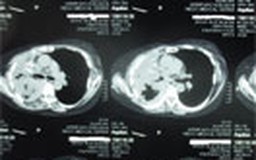Phát hiện nhiều hạt phóng xạ trong phổi một bệnh nhân