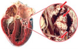 Mối liên hệ giữa bệnh gút và bệnh tim mạch