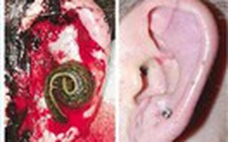 Nối tai thành công nhờ đỉa