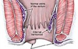 Cách chữa bệnh trĩ tận gốc để ngừa tái phát