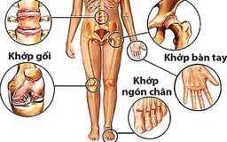 Bảy dấu hiệu nhận biết thoái hóa khớp