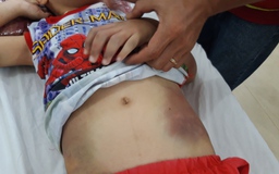 Bé trai 6 tuổi bị bạo hành dã man bị chấn thương phần mềm