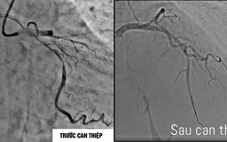 Can thiệp sớm, cứu sống 3 bệnh nhân bị nhồi máu cơ tim