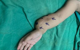 6 lần phẫu thuật chỉnh đôi tay bị khớp giả hiếm gặp trên thế giới