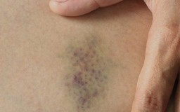Những nguyên nhân làm xuất hiện vết bầm tím trên da