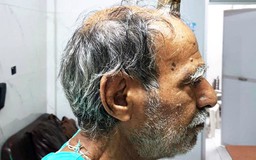 Bác sĩ ‘cưa sừng’ mọc trên đầu cụ ông Ấn Độ